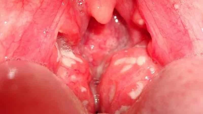 Chronic tonsillitis symptoms and treatment in adults treatment
