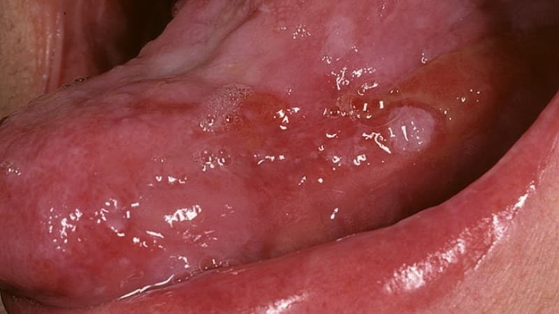 lichen planus pri oralnem zdravljenju