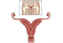 Doubling of the uterus photo