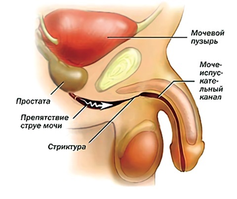 Urethrastriktur