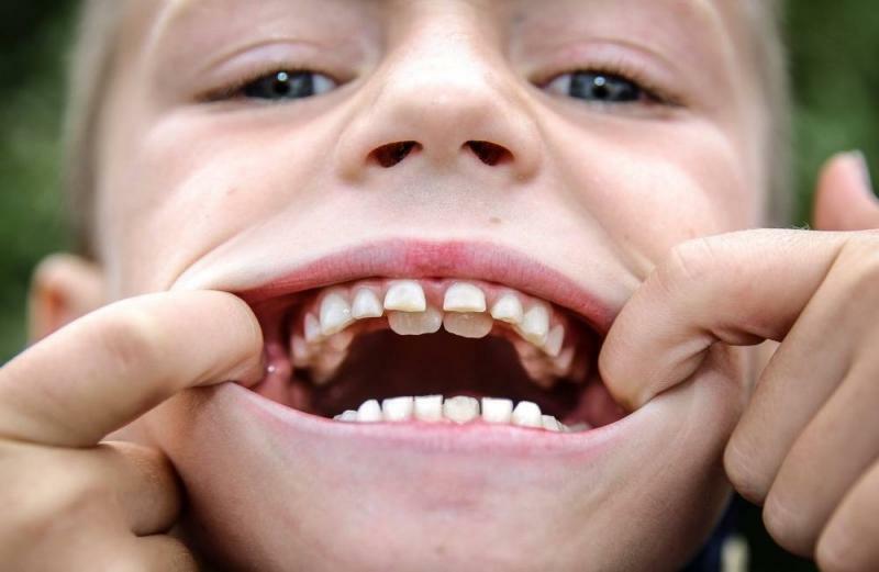 a segunda fileira de dentes em crianças