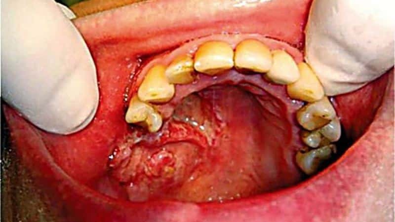 dentogene osteomyelitis van de kaak Symptomen