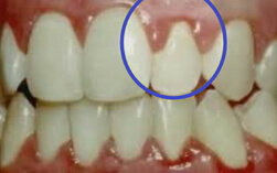 Granulating periodontitis