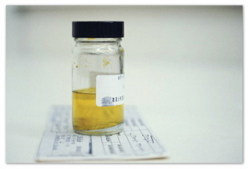 Normen för protein i urinen hos män och orsakerna till ökningen