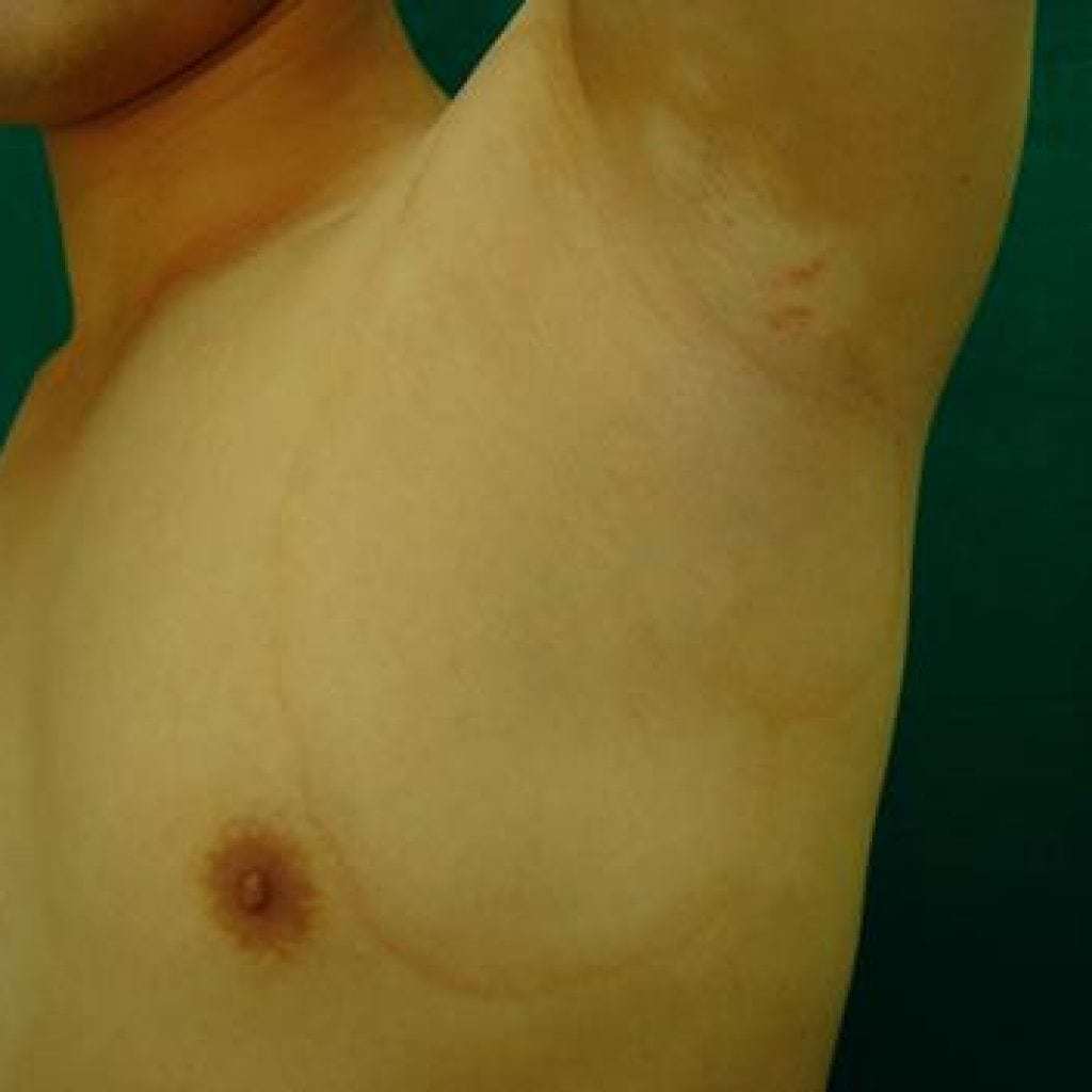 Vitiligo: što je to, fotografija, uzroci i liječenje bolesti