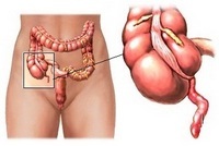 Peritonitis als een complicatie van navelhernie