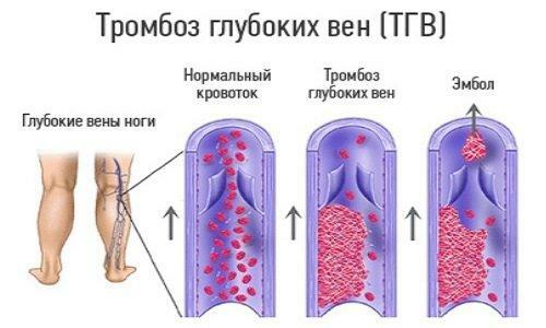 diéta trombóza