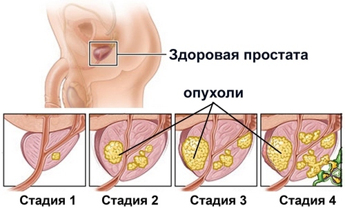 4 stages of prostate adenoma in men