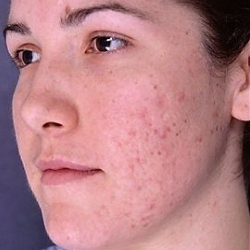 How to get rid of traces of acne: proven methods