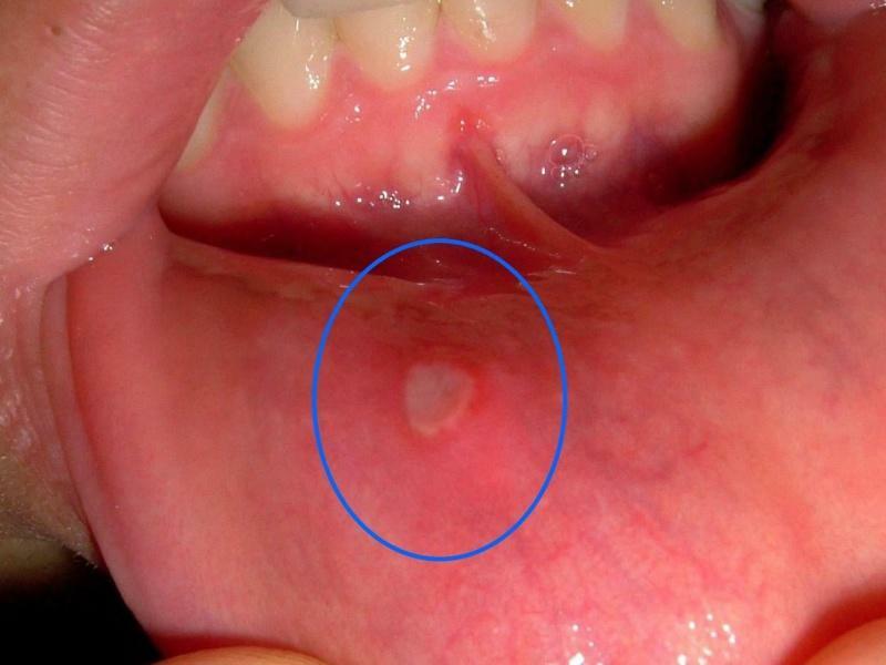 L'herpès à l'intérieur des lèvres: photo, traitement