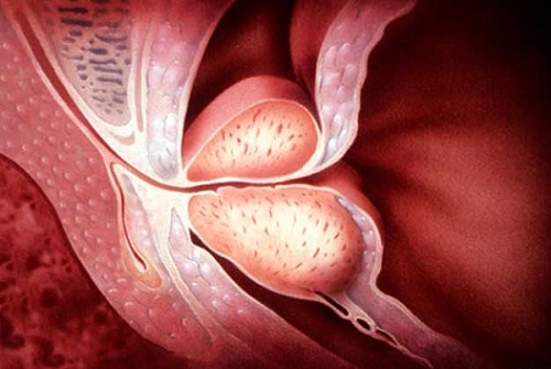 Везикулит у мужчин симптомы. Что такое везикулит предстательной железы. Семенные пузырьки везикулит. Воспаление семенных пузырьков.