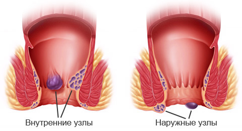prostatitis og hæmorider