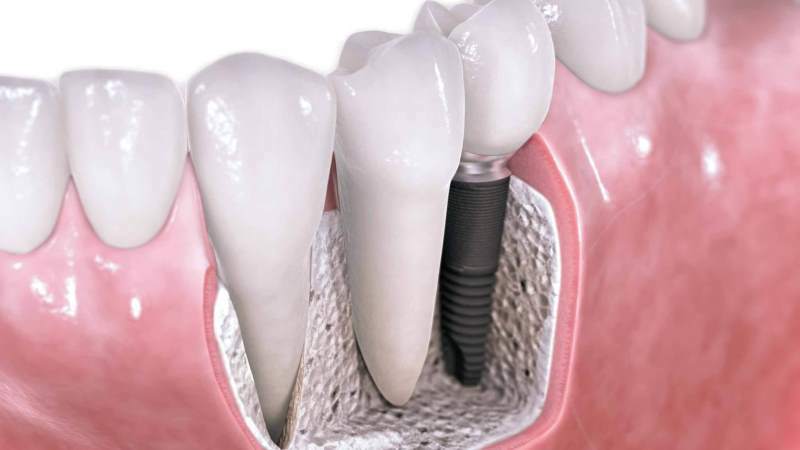 komplikaatioita istuttamisen jälkeen hampaiden alaleuan