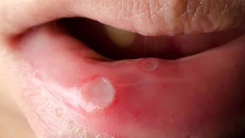 bolezni ustne sluznice