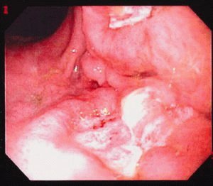 Gastritis bij een kind