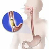 Esophagus narrowing: symptoms and treatment