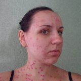 Treatment of chicken pox in an adult