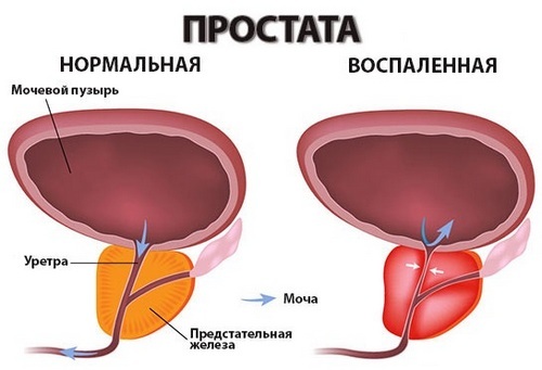 Inflammation of the prostate