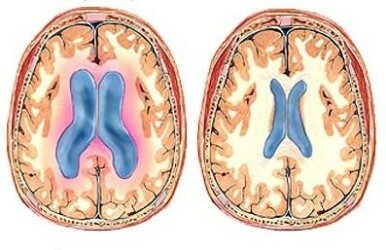 Znaki fetalnega hidrocefalusa