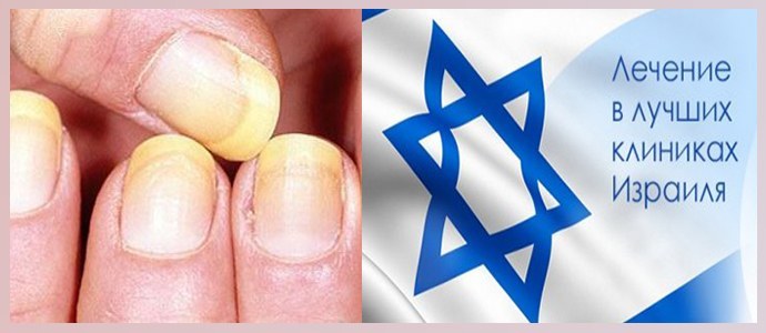 Behandeling van nagelschimmel in Israël