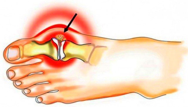 Signs and symptoms of gout in men