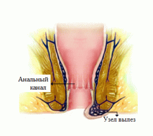 Hemorrhoidal veneuze trombose