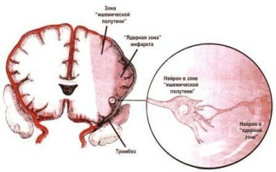 Causes, symptômes et traitement de l'ischémie cérébrale chez les nourrissons