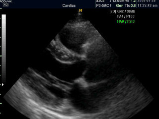 Ultrasound of the heart and interpretation of results