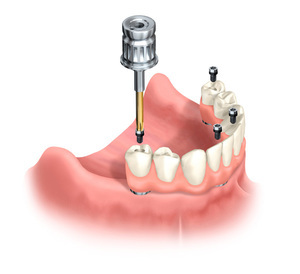 Kontra til anbringelse av dental tapp