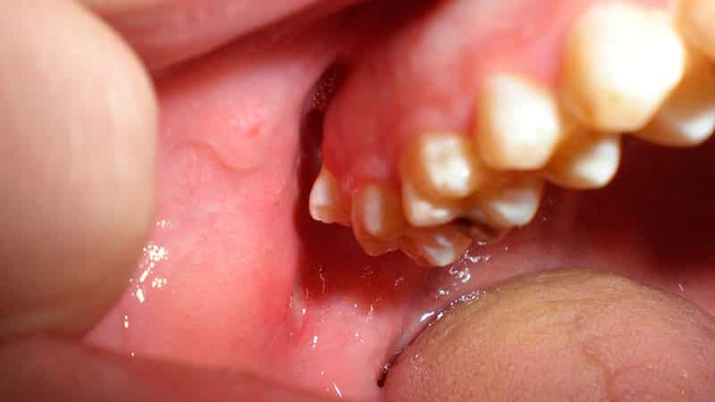 Comment traiter les ulcères de la bouche
