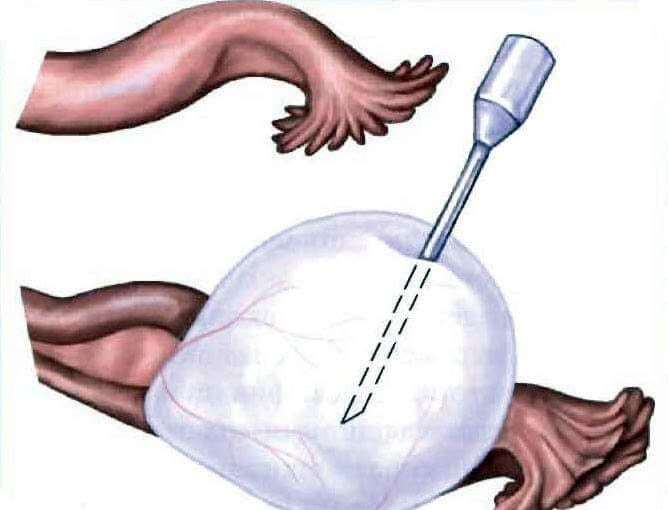 Cystectomy - surgical removal of an ovarian cyst