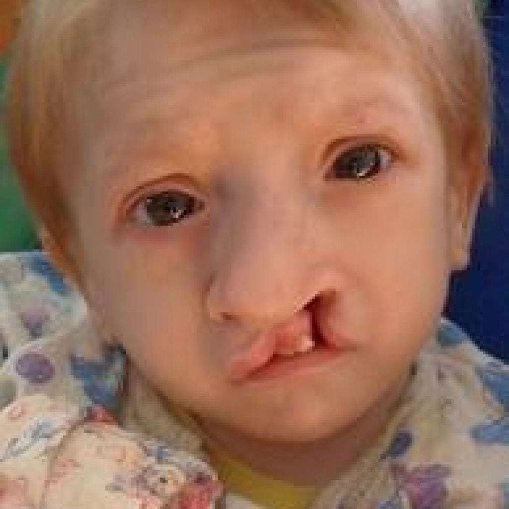 Edwards syndrome: photos of patients, causes, symptoms and treatment