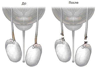 Im Detail über eine Vasektomie( Vasorektomie)