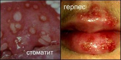 herpes Holisal di bibir