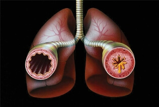Bronchial asthma pictures