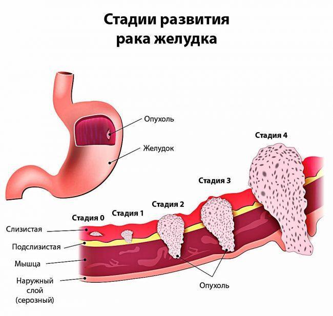 Stomach cancer and its stages of development Stomach cancer and its stages of development