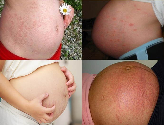 a dermatitis megnyilvánulása a terhesség alatt