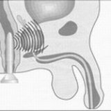 Inflammatoriska sjukdomar i prostatakörteln av seminala vesiklar