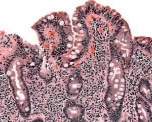 Steatorröa patoloogia