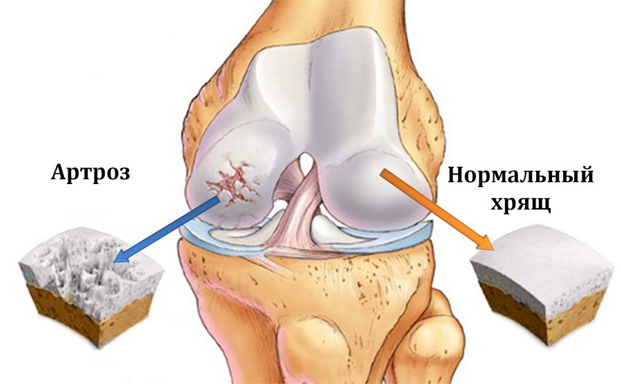 Osteoarthritis: types, causes, symptoms and treatment with medicines and folk remedies