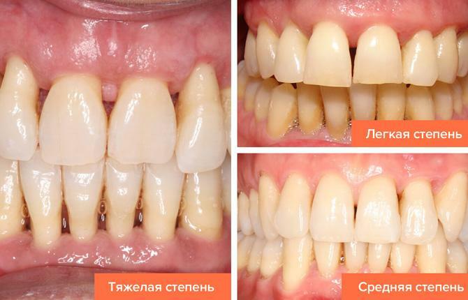 The degree of periodontal disease