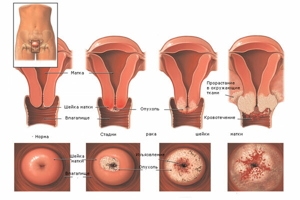 Erosion-cervical uteri_3