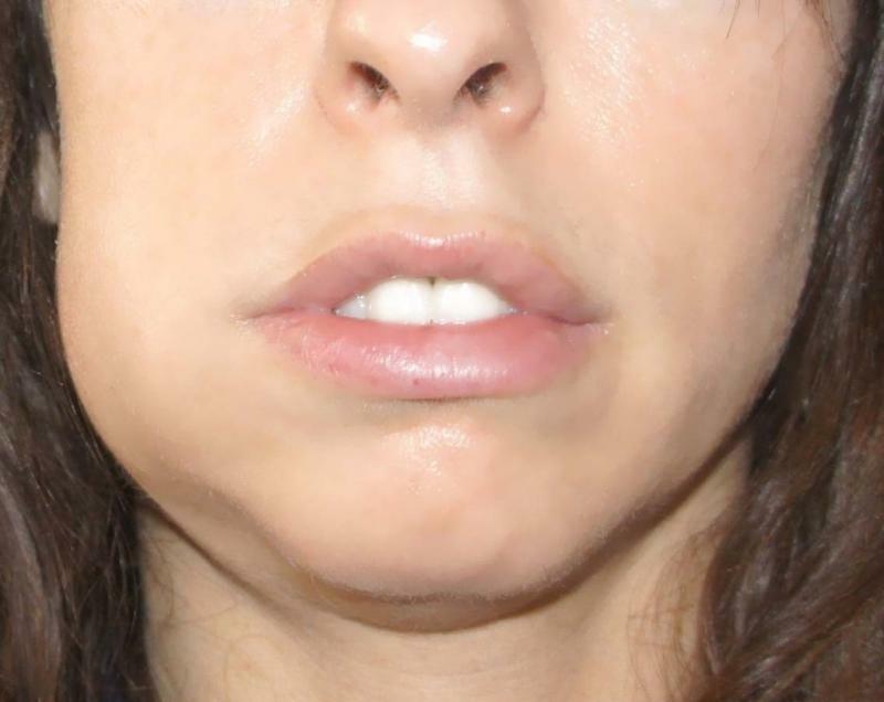 Stomatitis on the cheek: photo, treatment in adults and children