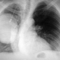 Maligni neepitelni tumori pluća