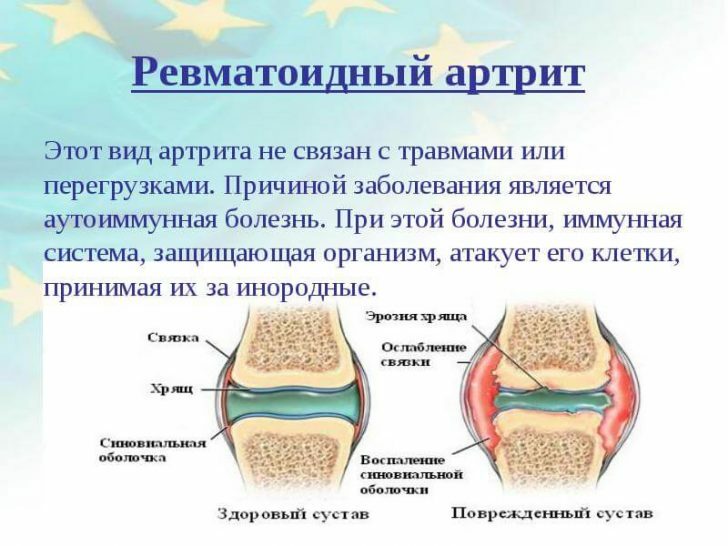 reumatoidni artritis