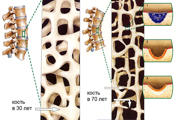 1. La osteoporosis senil