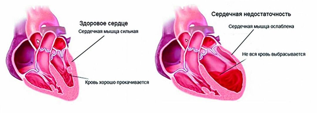 Hjertesvikt: symptomer, skjemaer, behandling