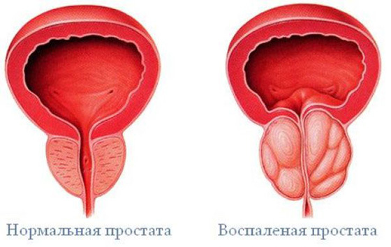 De första symptomen på prostatit och deras exacerbation