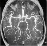 Tomography of cerebral vessels