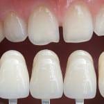 Fest skallfasetter på tennene